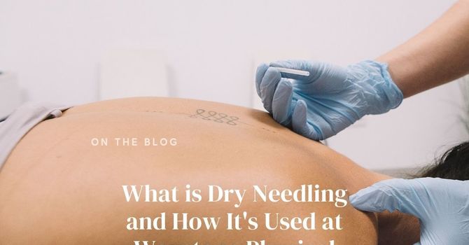 What is Dry Needling and How It's Used at Waystone Physical Therapy image